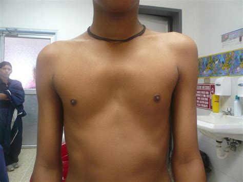 Pectus carinatum, also called pigeon chest, is a malformation of the chest characterized by a protrusion of the sternum and ribs. PECTUS ECUADOR - PECTUS CARINATUM