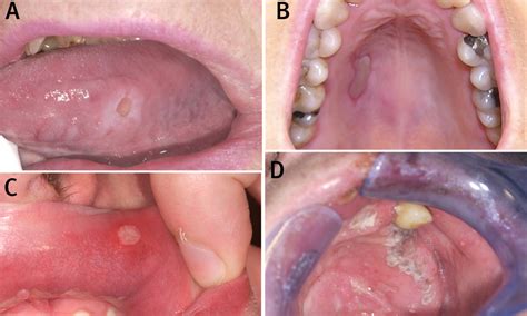 Mouth herpes may have symptoms on lips, around and inside the mouth. aphthous ulcers | Medical Pictures Info - Health Definitions Photos