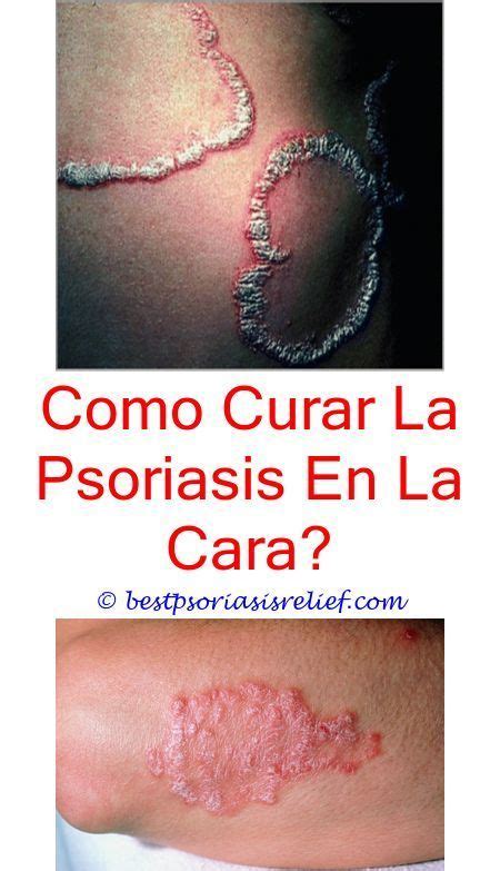 First, let's learn more about scalp psoriasis. psoriasisphoto can i dye my hair with psoriasis - steroid ...