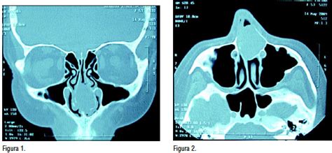 Published with reusable license by. Adenoma pleomorfo del septum nasal, dos casos clínicos y ...