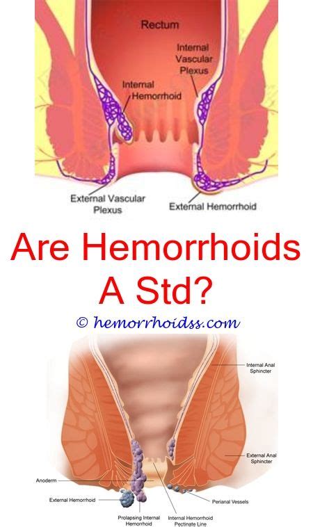 Most internal hemorrhoids are painless. 7 Centered Tips: Can You Treat Thrombosed Hemorrhoids At Home? where do internal hemorrhoids ...