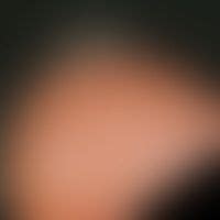 Diese seite informiert sie über den kreisrunden haarausfall und hilft ihnen, mit der. Bilder für Haarlosigkeit, Kopfhaut (behaart) - Altmeyers ...