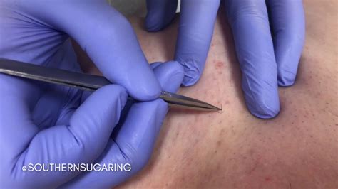 If your ingrown hair starts to fill with white or yellow pus, it's infected. Quick Ingrown Hair Extraction at Southern Sugaring - YouTube