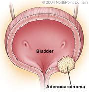 It can spread to nearby lymph nodes and other organs. Conditions - Bladder Cancer - Brown Urology Brown ...