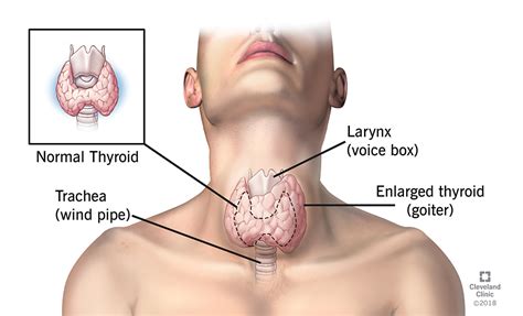 My thyroid gland and several lymph after my diagnosis, i went from not knowing much about what a thyroid gland does, to being in awe. बिकराल बन्दैछ ,थाइराइड समस्या « Himal Post | Online News ...