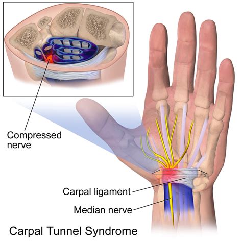 In this paper will review median nerve anatomy, clinical features of cts. Carpal Tunnel Syndrome Can Be Treated With Chiropractic Care