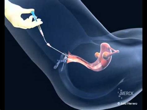 Know what is iui and how iui process works. Inseminación artificial - YouTube