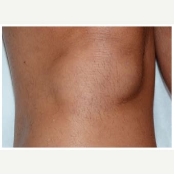 It is a great complement or replacement for laser hair removal done at the dermatologist's office. Laser Hair Removal Before & After Pictures - RealSelf