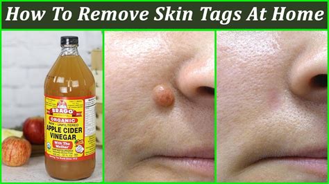 How to remove skin tags easily at home? How To Remove Skin Tags at Home : 7 Best Skin Tag Removal ...