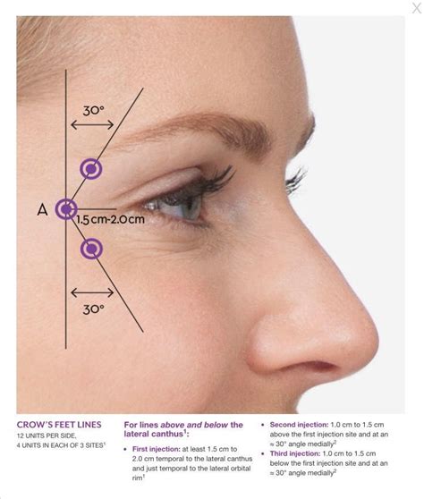 Jan 01, 2010 · the new botox ® is comparable in clinical efficacy and safety to the old, and a unit dose of new botox ® provides an equivalent response to the same unit dose of old botox ®. Pin on Crows Feet Products