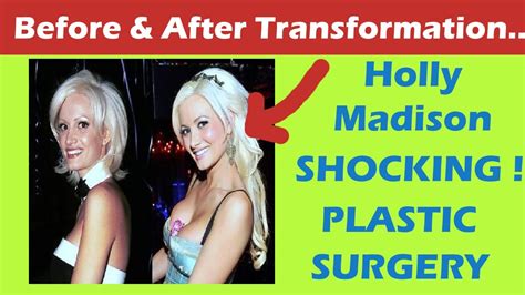 Mohs surgery and skin cancer reconstruction. Holly Madison Plastic Surgery Before and After Full HD ...