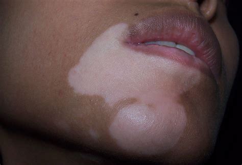 Dermalight (дермалайт) 311 uvb | лечение витилиго и псориаза ультрафиолетом 311 нм. Vitiligo - Causas, Diagnóstico, Tratamentos e Prevenção ...