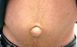 There is a high risk of strangulation with intestinal obstruction or intestinal ischemia. Umbilical Umbilical Hernia, Medical Treatment Services - Pelvinic, New Delhi | ID: 14328820862