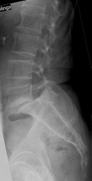 ספונדילוליסטזיס - Spondylolisthesis - ויקירפואה