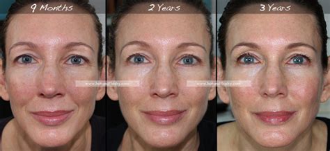 Maybe you would like to learn more about one of these? Retin-A for Wrinkles | 3-Year Results | Before & After ...