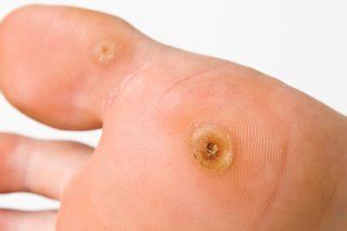 Warts are typically small, rough, hard growths that are similar in color to the rest of the skin. Warts & Verrucas