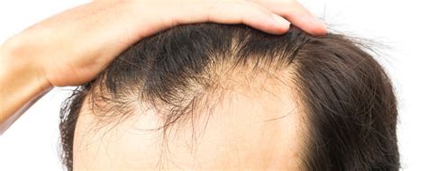 There is no reliable medical evidence to support this claim. Limmer HTC | Does Laser Hair Therapy Really Work?