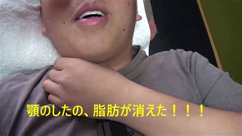 顎の肉が消えた 瞬間 たるみ 脂肪 実録 - YouTube