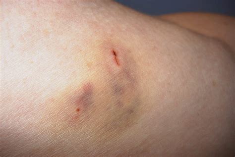 They could cause a lot of irritation and harm. A Dog bit me, What should I do? - BeingTheDoctor
