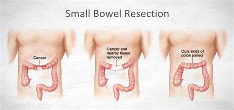 Diagnostic testing can rule these out. Colon Cancer Surgey Texas: Dr. Valeria Simone MD