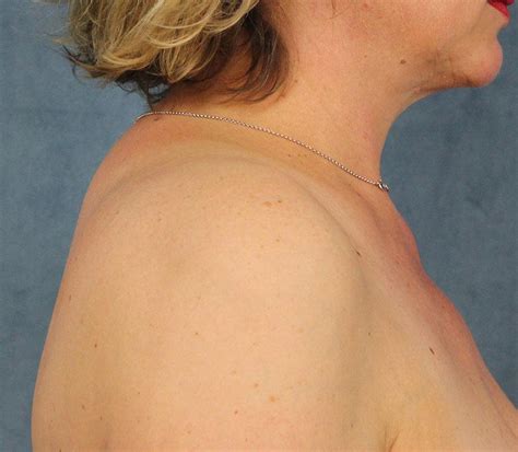 If you have osteoporosis of the spine, your vertebrae can fracture. 거북목(앞쪽머리자세, forward head)