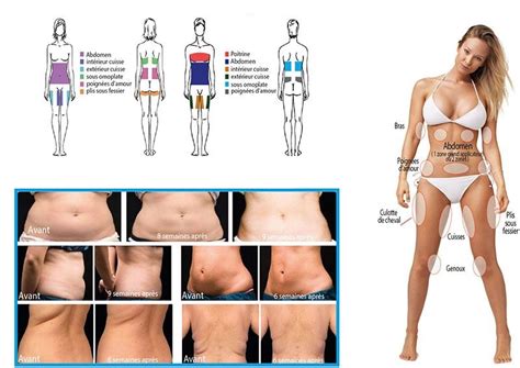 Liposuccion à lyon par le chirurgien plastique damien van der stegen +20 ans d'expérience. Les technologies d'amincissement Lyon 69 - Diététicien ...