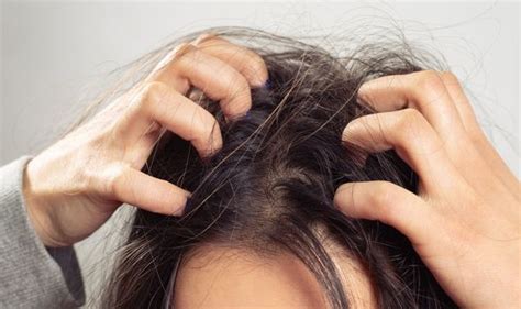 Dry scalp can cause hair loss. Can dandruff cause hair loss? | Express.co.uk