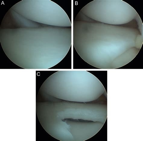 The endoscope is inserted into the joint through a small incision and is a procedure used to treat. Lateral discoid meniscus. (a, b) Images taken during knee ...