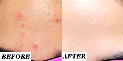 Ours is a gentle formula so it may take some time. This Retinol Before-and-After Acne Treatment on Reddit Is ...