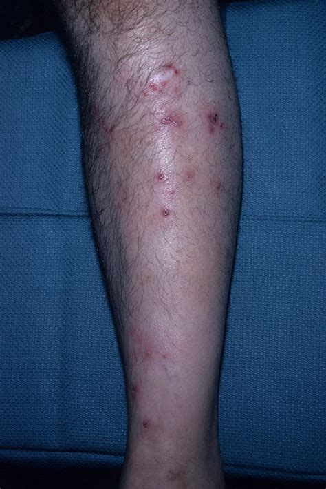Herpes simplex virus, more commonly known as herpes affects 1 in 6 people. Herpes on Feet Pictures - 11 Photos & Images / illnessee.com