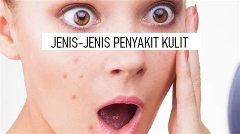 Penyakit kulit hemanogioma yakni jenis kanker jinak terjadi disebabkan pertumbuhan jaringan darah tidak normal. JENIS-JENIS PENYAKIT KULIT - Nasium.org