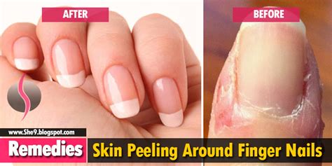 Use aloe vera and other products to help if your skin is peeling from a sunburn, avoid showers and hot water, as the force and temperature of all peeling skin removal processes take multiple treatments, usually over the course of several days. Skin Peeling around Finger Nails | Causes, Consequences ...