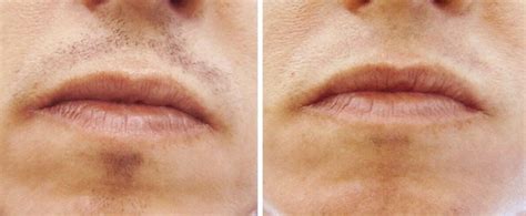 In the majority of cases, this is just relax! Laser Hair Removal Upper Lip Cost, Reviews, How Many ...