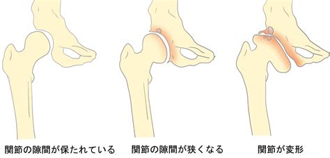 股関節の痛みの原因 変形性股関節症の症状や治療法【金沢市の ...