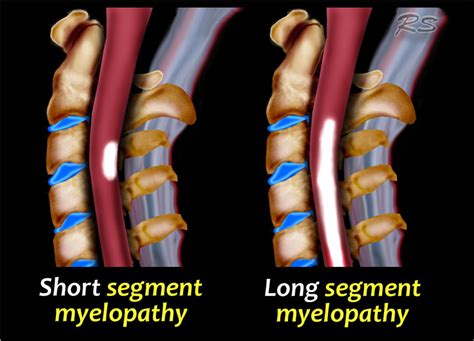 Transverse myelitis postsurgical spine avm brachial plexus post radiation therapy, eval for mass lesions, entrapment, denervation cervical spine w and w/o contrast 72156 thoracic disc disease pain radiculopathy trauma thoracic spine w/o contrast 72146 tumor infection ms syrinx transverse myelitis postsurgical spine avm The Radiology Assistant : Spine - Myelopathy