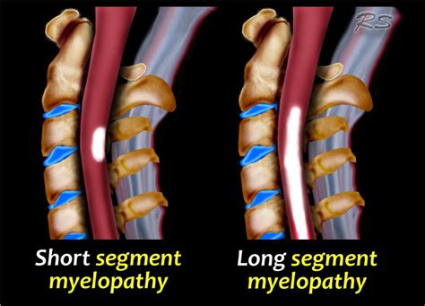 Transverse myelitis may occur in isolation or in the setting of another illness. The Radiology Assistant : Spine - Myelopathy