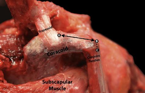 Specifically, the four rotator cuff muscles include the following Dissected cadaveric right shoulder showing the coracoid ...