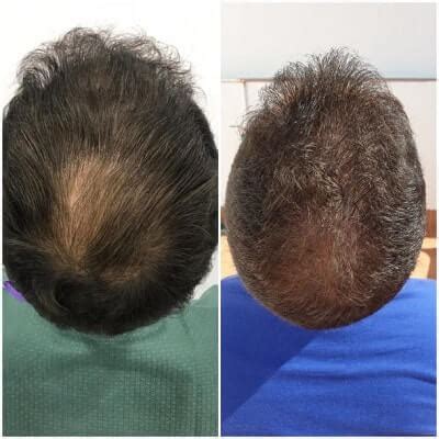 Most hair loss sufferers also take the same dosage. Hair Loss Treatment Guideline Update | Hair Loss Cure 2020