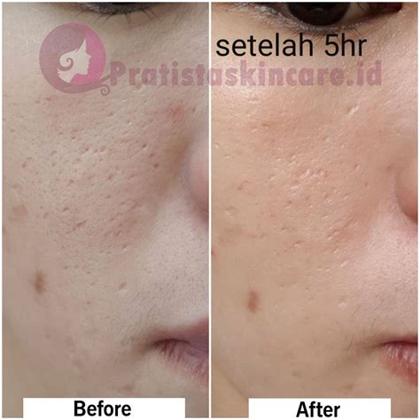 Tapi bukan menyimpang dari judul, tetap seputar cara menghilangkan bopeng tapi bukan menggunakan obat. Cream Serum Penghilang Bopeng Pratista Bekas Jerawat & Cacar