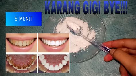 Berikut cara menghilangkan karang gigi yang dirangkum suara.com dari berbagai sumber. PEMUTIH GIGI DENGAN SODA KUE - CARA MENGHILANGKAN KARANG ...