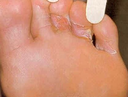 Fungal organisms enter body through small cuts or cracks in your skin. Foot Fungus - Pictures, Types, Causes, Symptoms, Treatment ...