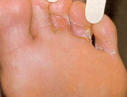 The making of ski mask the slump god's foot fungus with kenny beats | deconstructed. Foot Fungus - Pictures, Types, Causes, Symptoms, Treatment ...