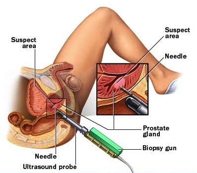 You will find many male to female massage parlor in the delhi. Thulium Laser VapoEnucleation of the Prostate(THULEP ...