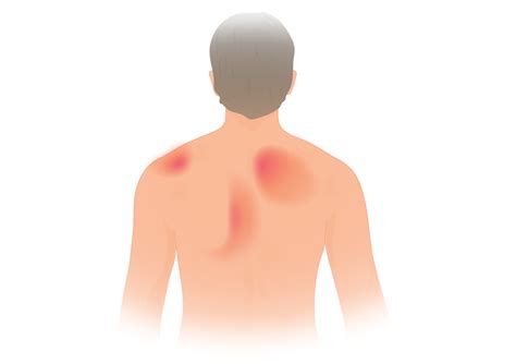 / large lump on back near. Pain in and Under the Shoulder Blade: Your Guide to Pain ...