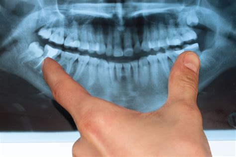 A retrospective study of 1,199 cases in the mandible. What you should know about wisdom teeth, complications ...