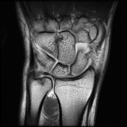 Ortho eval pal with paul marquis pt. TFCC tear (Palmer Ia) | Image | Radiopaedia.org