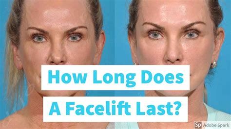 If you don't want to share, here's what the stats say. How Long Does A Facelift Last? - Answered by Dr. John ...