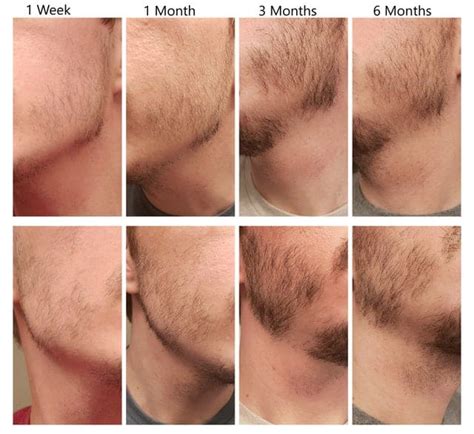 Minoxidil liquid is the original form of application and comes in a 5% extra strength rogaine version for men. Beard growing longer on one side? Try these simple tricks...