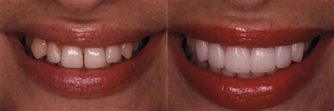 The material is shaped to look natural and then hardened with a special light, which ultimately bonds it to the tooth to close the gap in your smile. Gapped Teeth