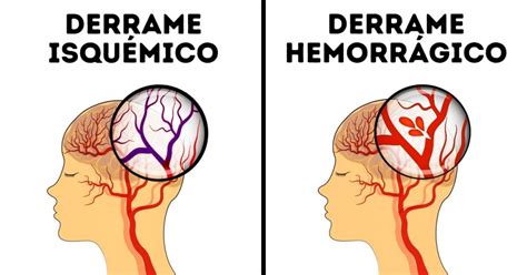 En muerte cerebral un conductor de autobús tras ser agredido por no dejar subir a pasajeros sin mascarilla. ¿Qué es un derrame cerebral? ⚡️ » Respuestas.tips